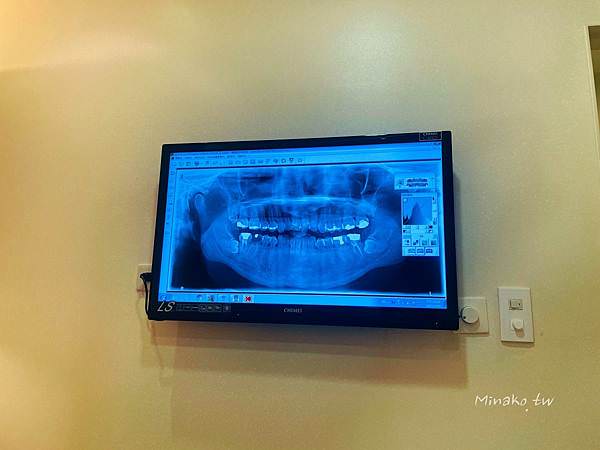 ​​SOV牙齒矯正初診X光
