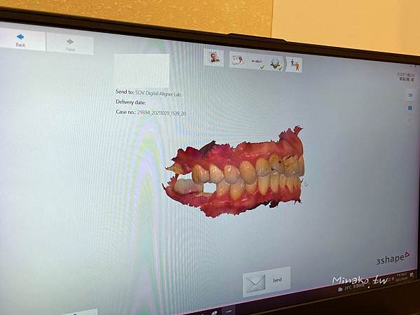 ​​SOV牙齒矯正初診數位口掃模型