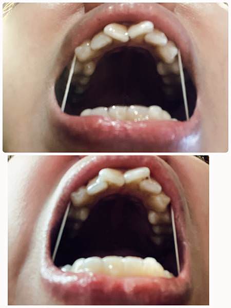 SOV隱形牙套心得矯正暴牙兩個月變化