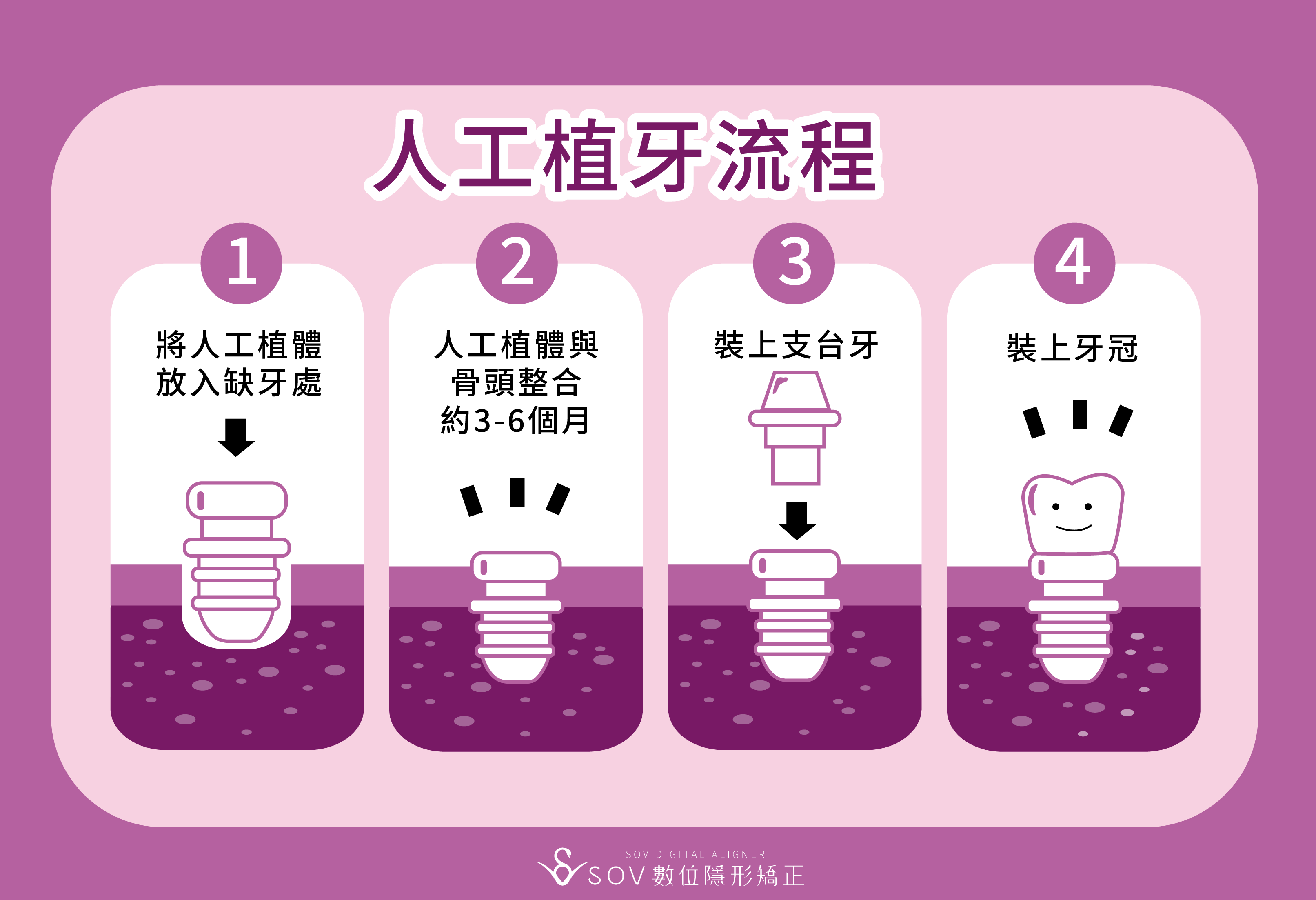 人工植牙流程與感想