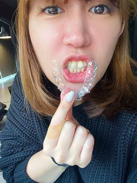 SOV隱形牙套矯正｜為什麼要用維持器